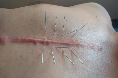 Dry needling is the treatment in which very fine f...