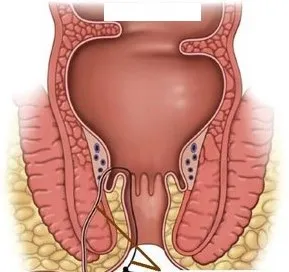 WHAT IS KSHAR SUTRA THERAPY AT SUKHAYU HOSPITAL? K...