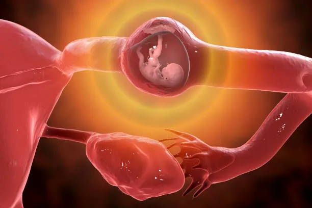 Ectopic pregnancy An ectopic pregnancy is when a f...
