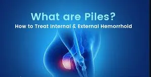 Experience relief from piles and related condition...