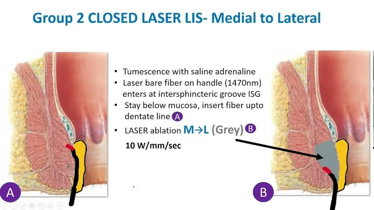 Laser Sphincterotomy or LASER treatment is opted w...