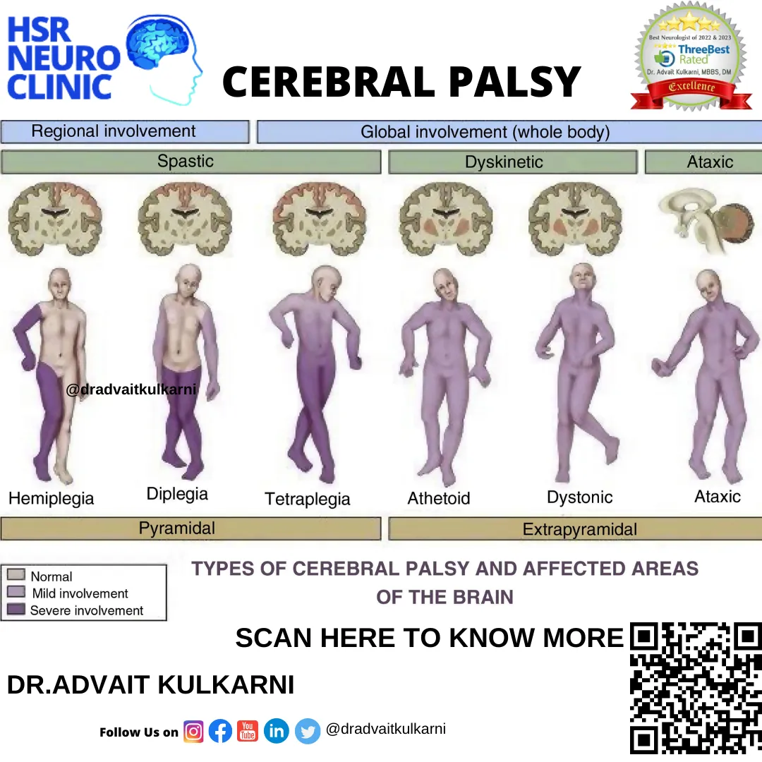 Diagnosis
Signs and symptoms of cerebral palsy can...