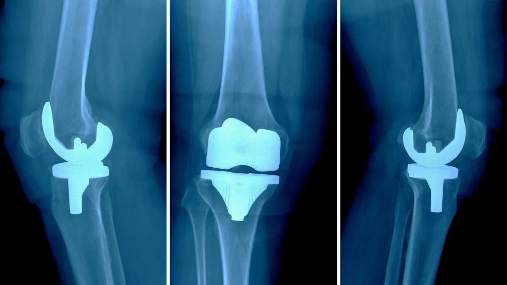 Knee Replacement In Nagpur.Knee Replacement
Knee r...