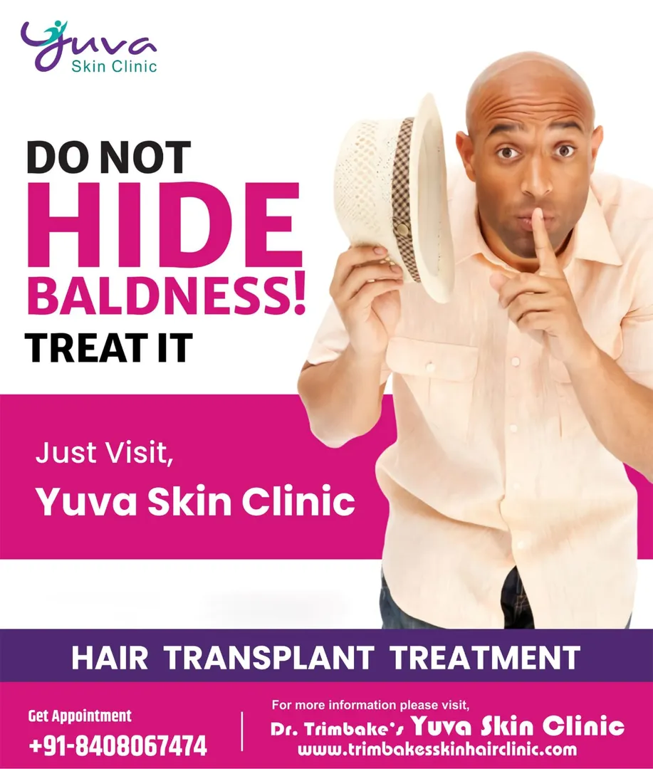 Now no need to hide your baldness, forgot the worr...