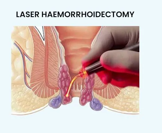 The laser hemorrhoids surgery helps in minimizing ...