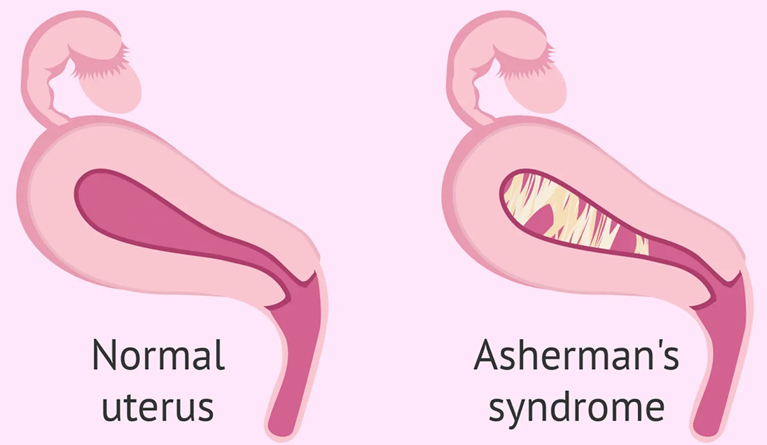 Asherman's Syndrome Definition Asherman syndrome i...