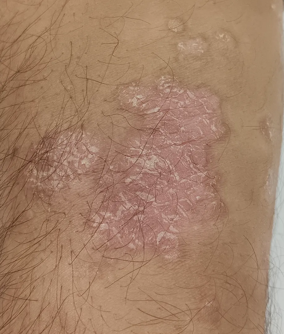 Homoeopathic Clinic For Psoriasis treatment in Pun...