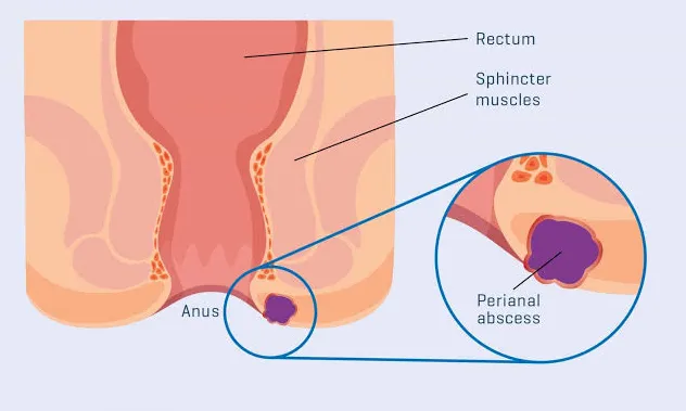 Perianal Abscess:-
A collection of pus in the tiss...