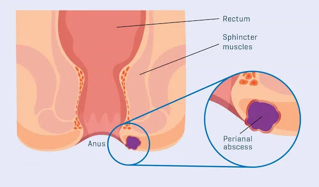 Treatment of Perianal Abscess:-
As a rule, the pre...