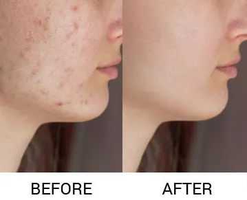 Reveal Youthful Radiance with CO2/Laser MnRF Treat...