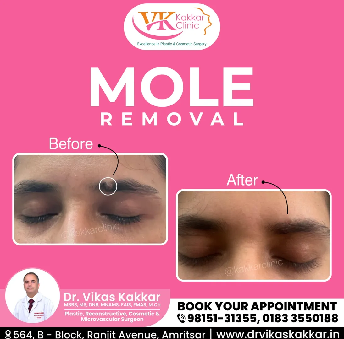 Mole Removal Before/After
There's no elevator to s...