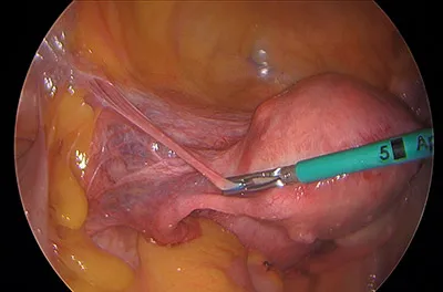 Successful Laparoscopic Hysterectomy Performed on ...