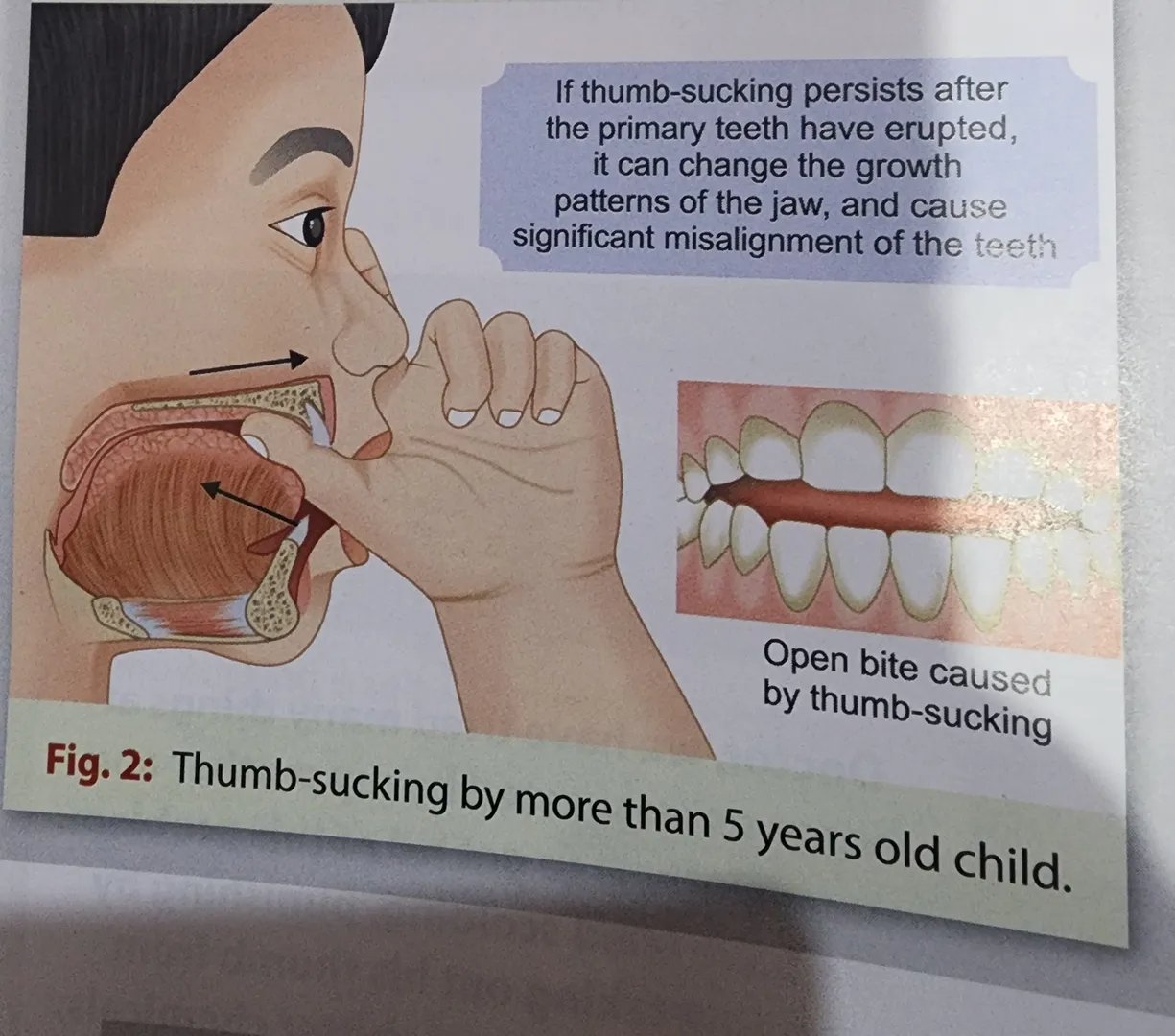 Paediatrician in Indirapuram .
Regarding Thumb Suc...