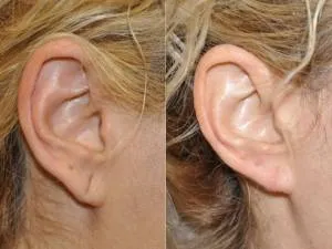Are You Finding Ear Lobe Repair Clinic in Rahatani...