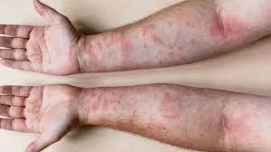 "Rediscover Healthy Skin Homoeopathic Solutions fo...