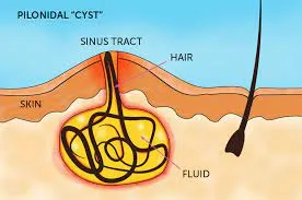 "Expert Piles Treatment in Pune - Your Solution to...