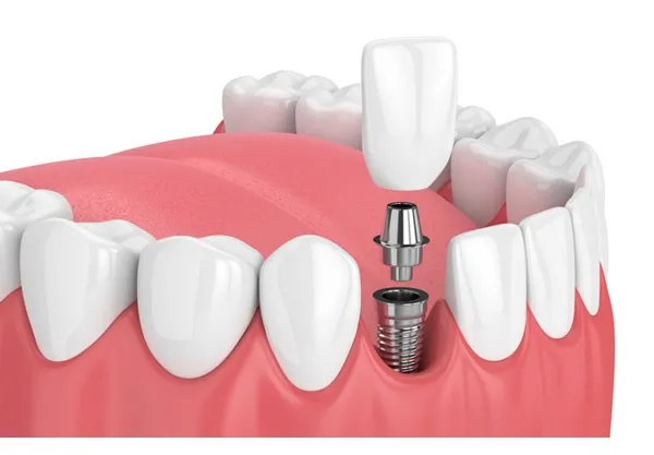 dental clinic near me
PD Dental Clinic and Impla...