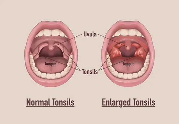 Need Tonsillectomy Treatment Clinic in Rahatani, K...