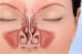 Do you need Adenoid Surgery Clinic in Rahatani, Ka...
