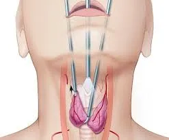 Finding Thyroid Surgery Treatment in Rahatani, Kal...
