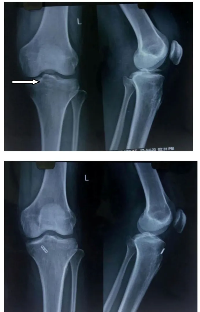Anterior cruciate ligament (ACL) avulsion fracture...