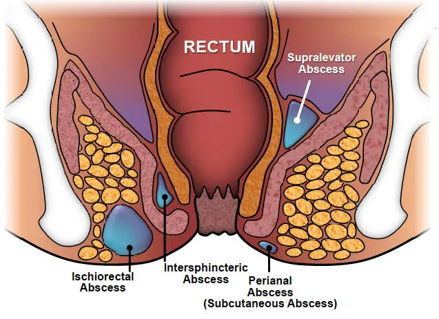 Anorectal Abscess:-
Symptoms--
Discharge of pus f...