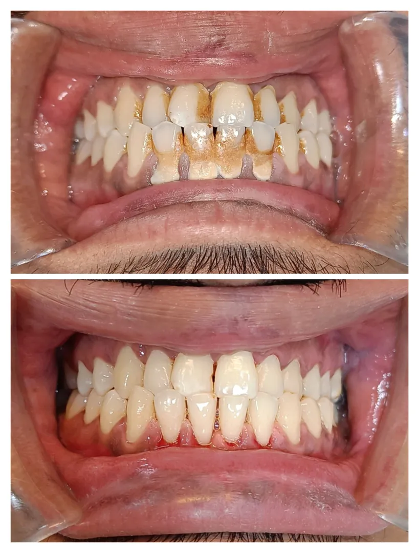 scaling and polishing
Good oral health is the co...