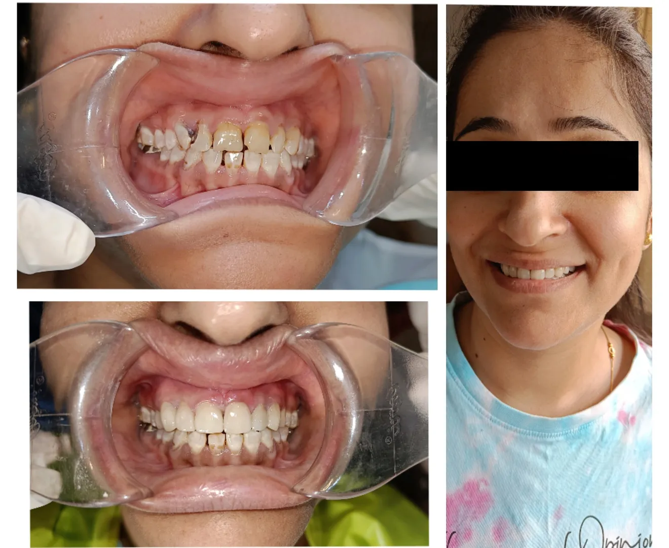 Dental Emax Veneers and Laminate
Title: Enhanci...