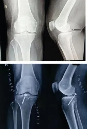 Posterior cruciate ligament (PCL) avulsion fractur...