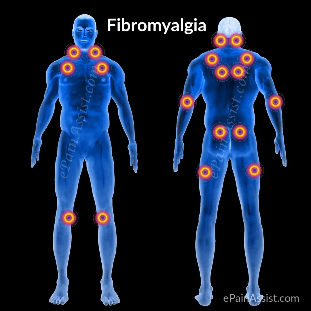 Understanding Fibromyalgia: A Comprehensive Guide ...
