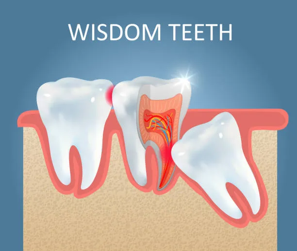 #Third Molar Surgical Extraction
Third molar ex...