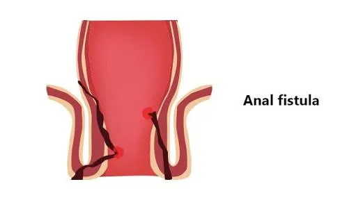 Anal Fistula:
An infected tunnel between the skin...
