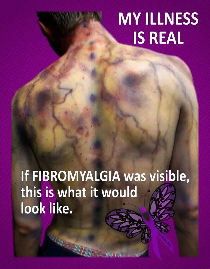 Fibromyalgia is a chronic disorder characterized b...