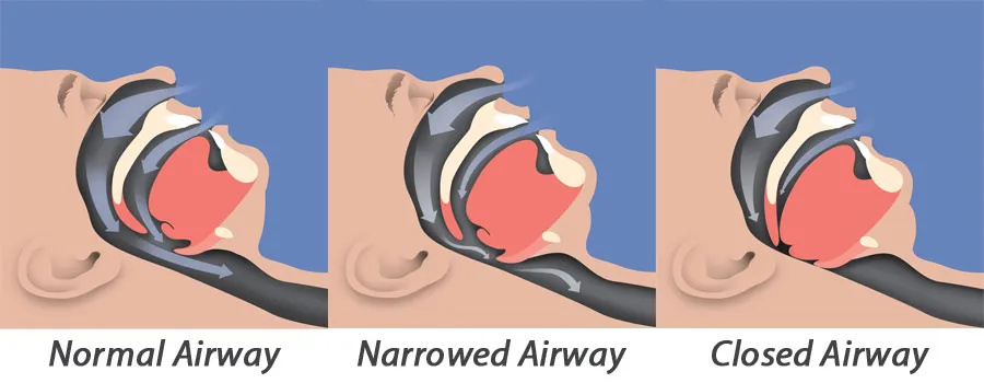 Sleep Apnea Causes and Treatments
Sleep apnea is ...