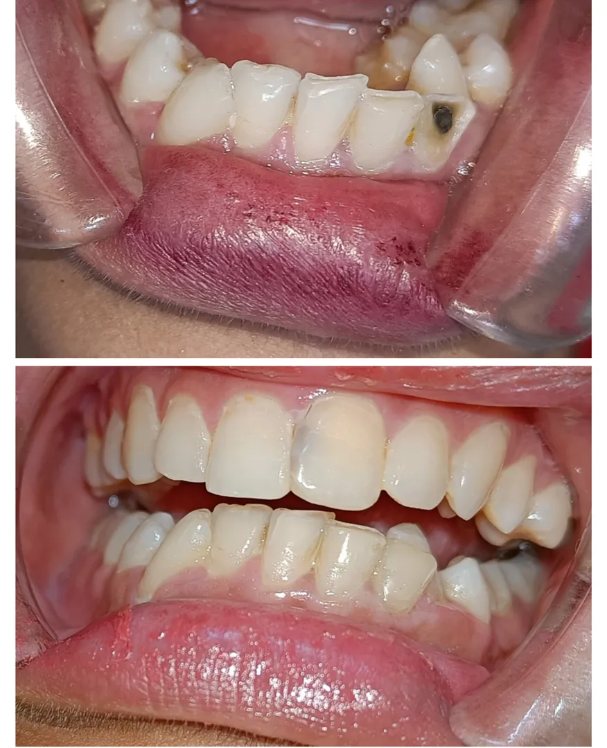 #composite restoration
#tooth coloured filling
#a...