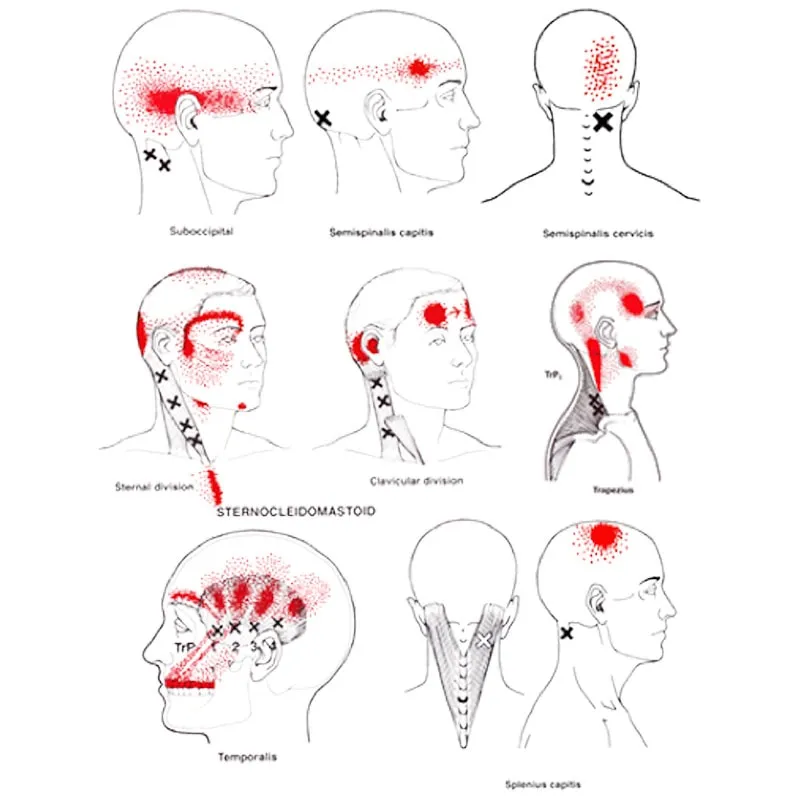 Understanding Cervicogenic Headaches: When Neck Pa...