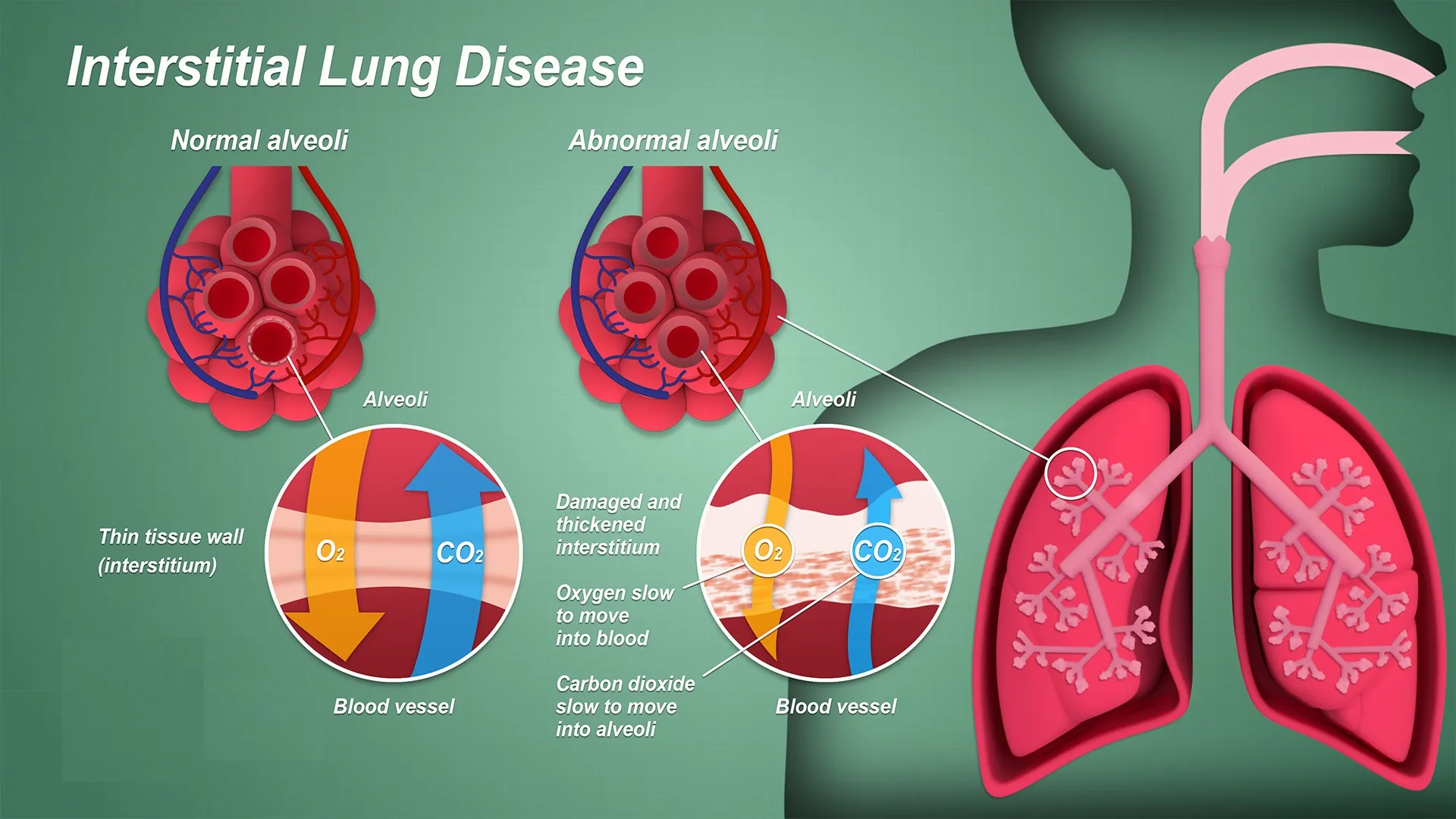 Why do COPD and ILD Patients need Oxygen ?
Patien...