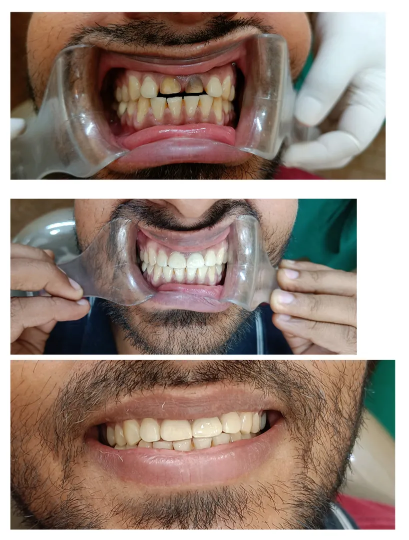 #zirconiumcrown
#allceramiccrown
#aesthetic dentis...