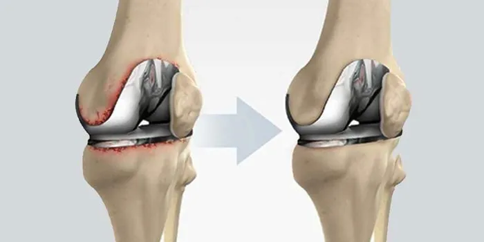 Revision Joint Replacement
Joint revision is a ty...