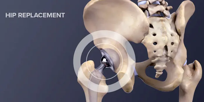 Hip Replacement surgeon in nashik
Hip replacement...