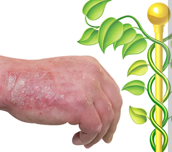 Homoeopathic Clinic for Psoriasis Reclaim Your Ski...