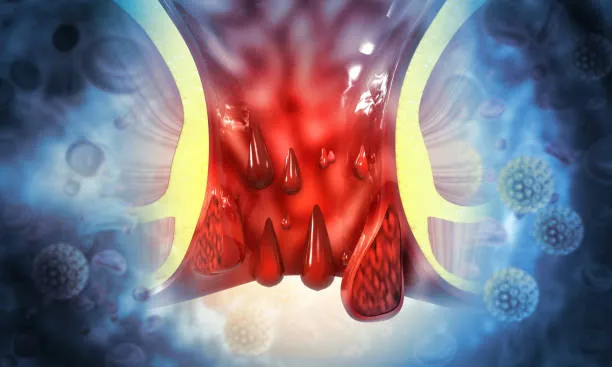 "Eating Right for Hemorrhoid Relief: A Comprehensi...