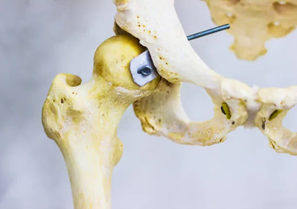 "Hip Replacement in Nashik: Your Road to Mobility"...