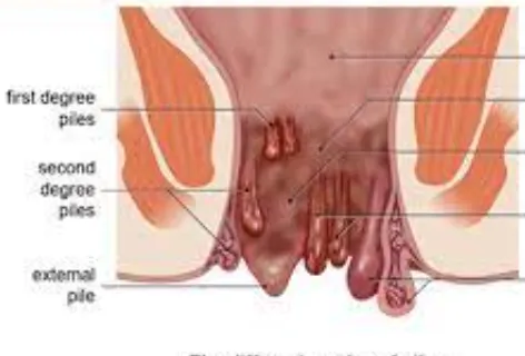 "Piles and Fissures: Recent Medical Developments a...