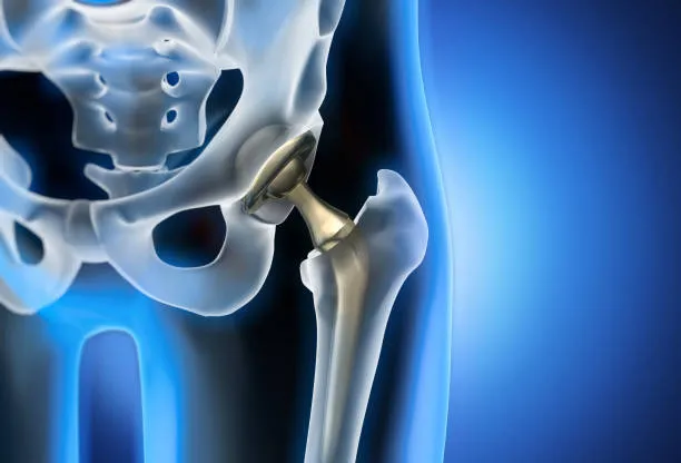 "Best Doctor for Hip Replacement in Nashik: Regain...