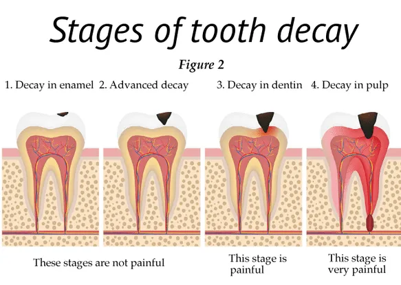 Introduction:
Dental caries, commonly known as t...