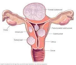 Uterine Fibroids: The Basics - What Are They? Uter...