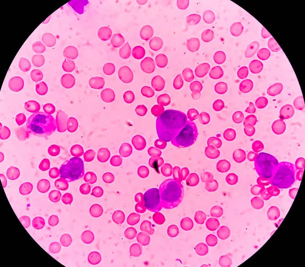 Best Leukemia Expert Near Me: Dr. Atish Bakane, Na...