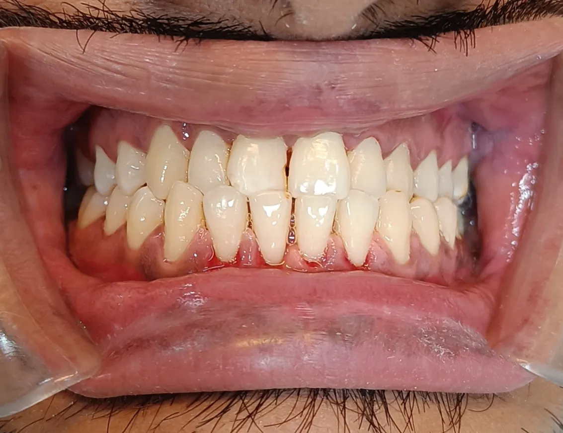 #bleedinggums
#gingivalbleeding
#swellengums
#scal...