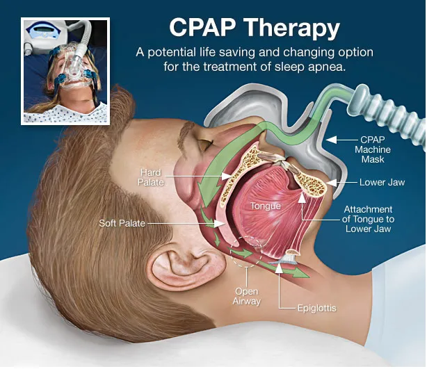 CPAP Therapy Continuous positive airway pressure (...